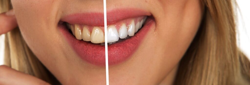 teeth, dental care, white, white teeth, hygiene, dental hygiene, tooth, dentistry, personal hygiene, dentist, clean, health, maintenance, to clean, mouth, brush teeth, cleanliness, attractive, smile, toothpaste, teeth, teeth, teeth, teeth, teeth, white teeth, dentist